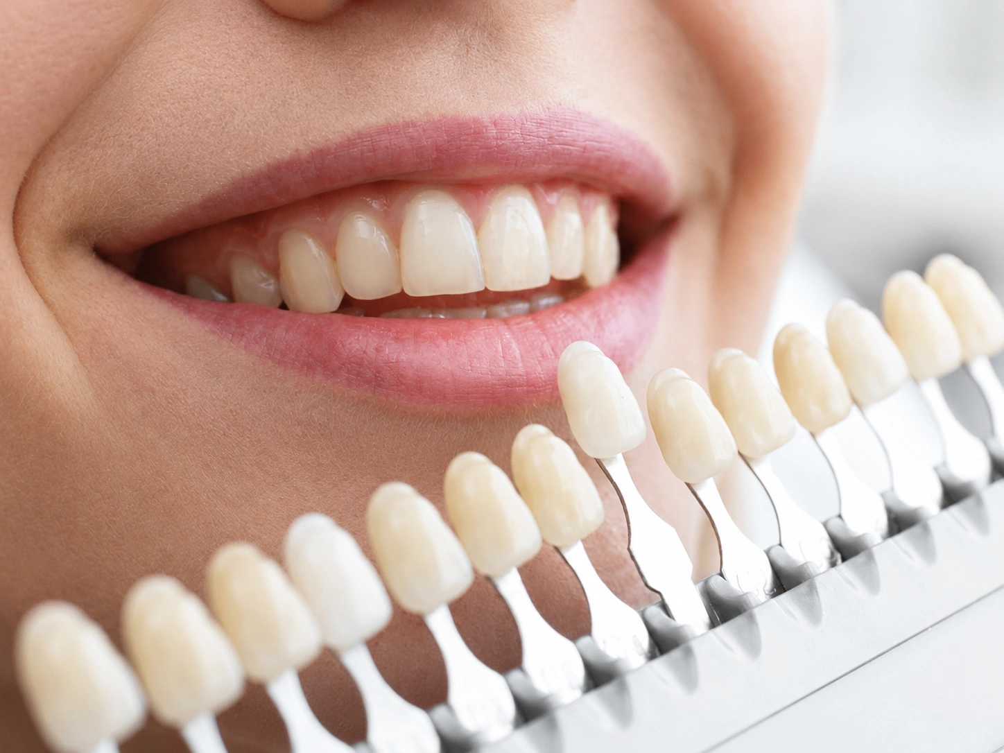Branqueamento dentário Porto Smile