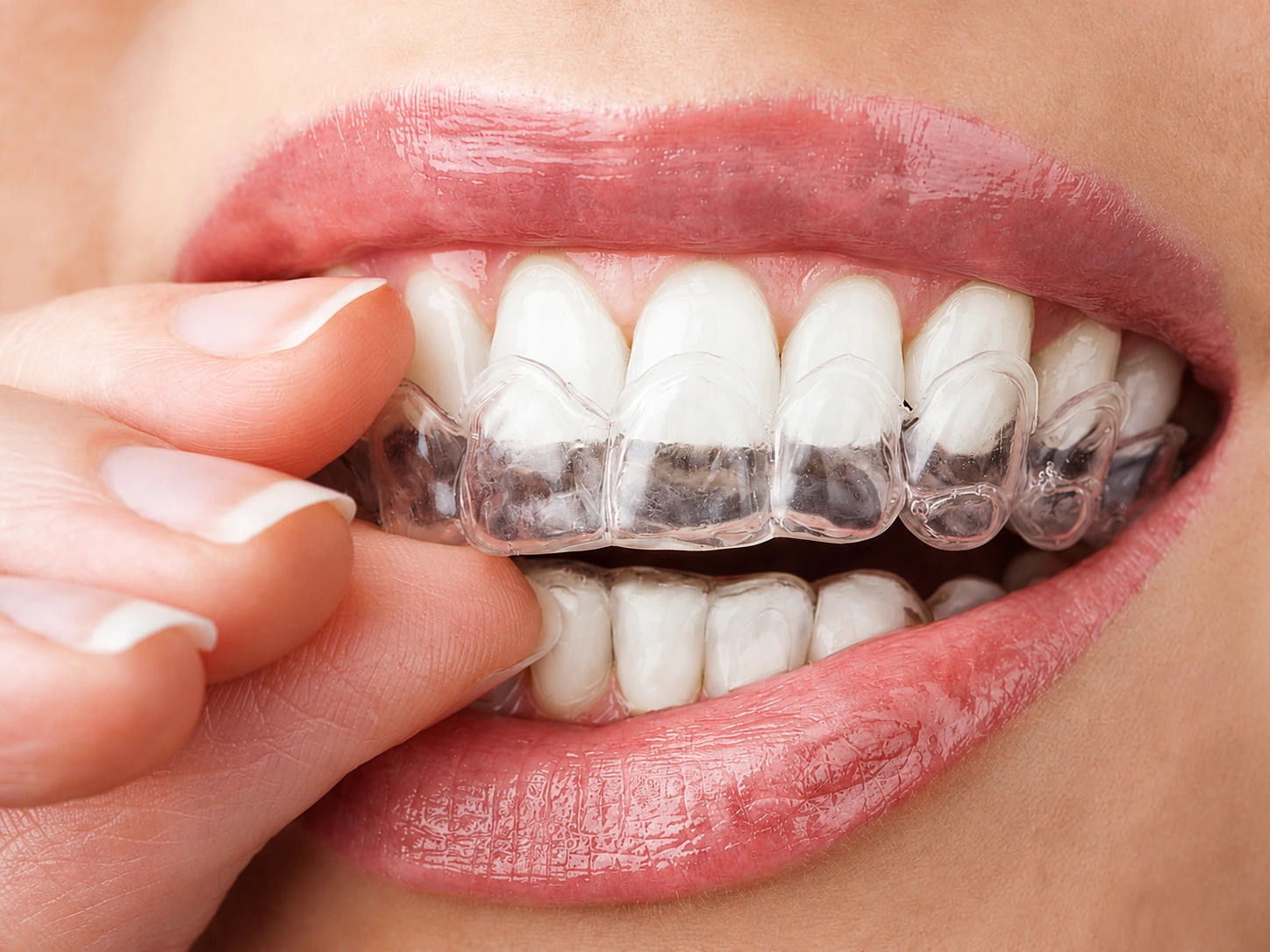 Resultado branqueamento Porto Smile