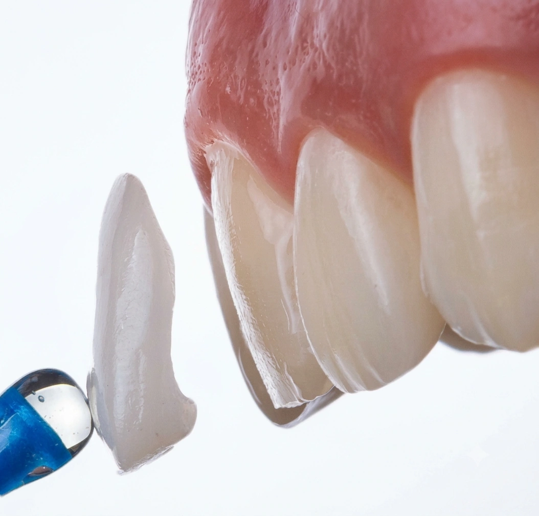 Caso clínico facetas dentárias Porto Smile