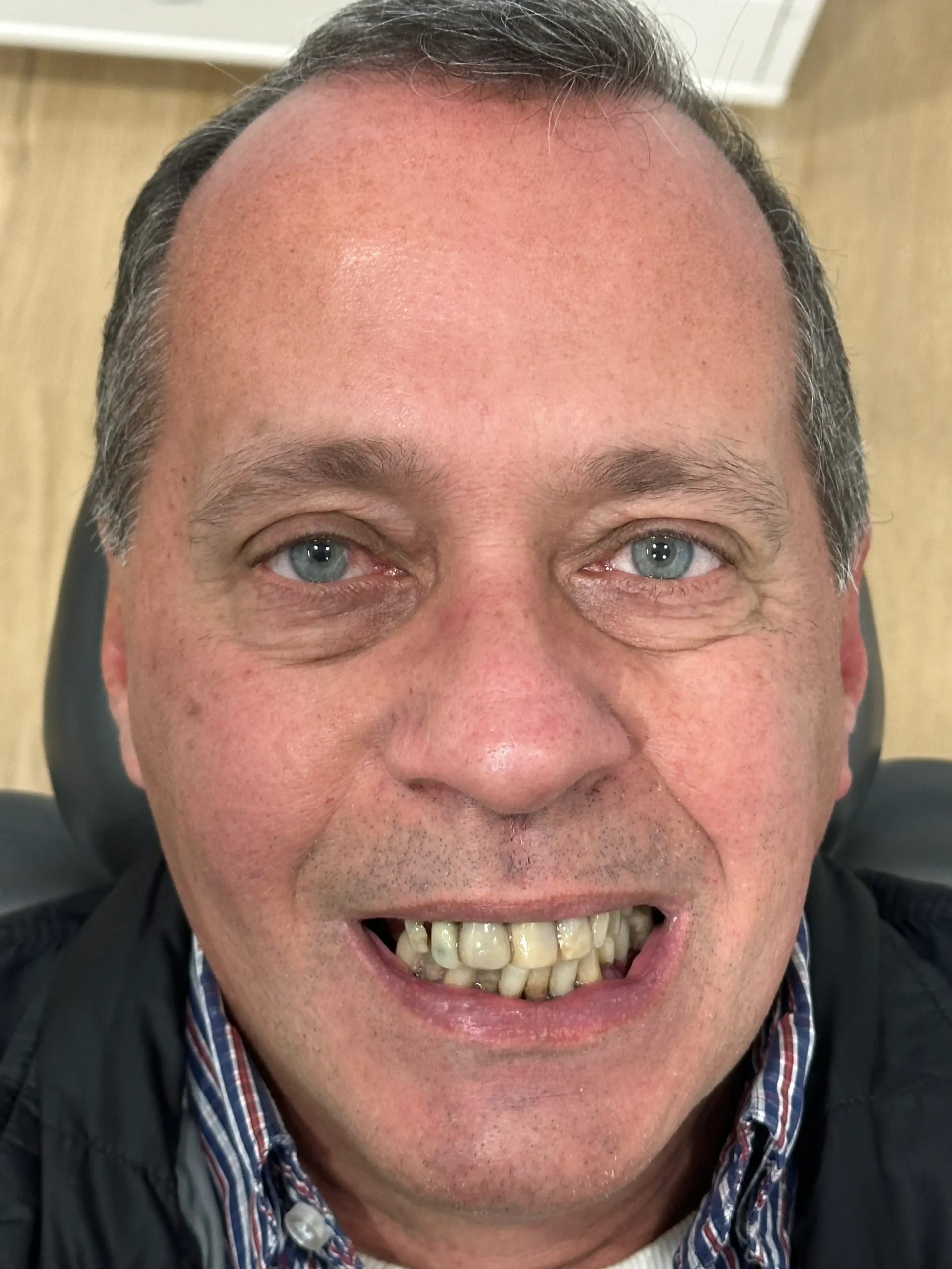 Caso real de reabilitação All-on-4 na Porto Smile — antes do tratamento