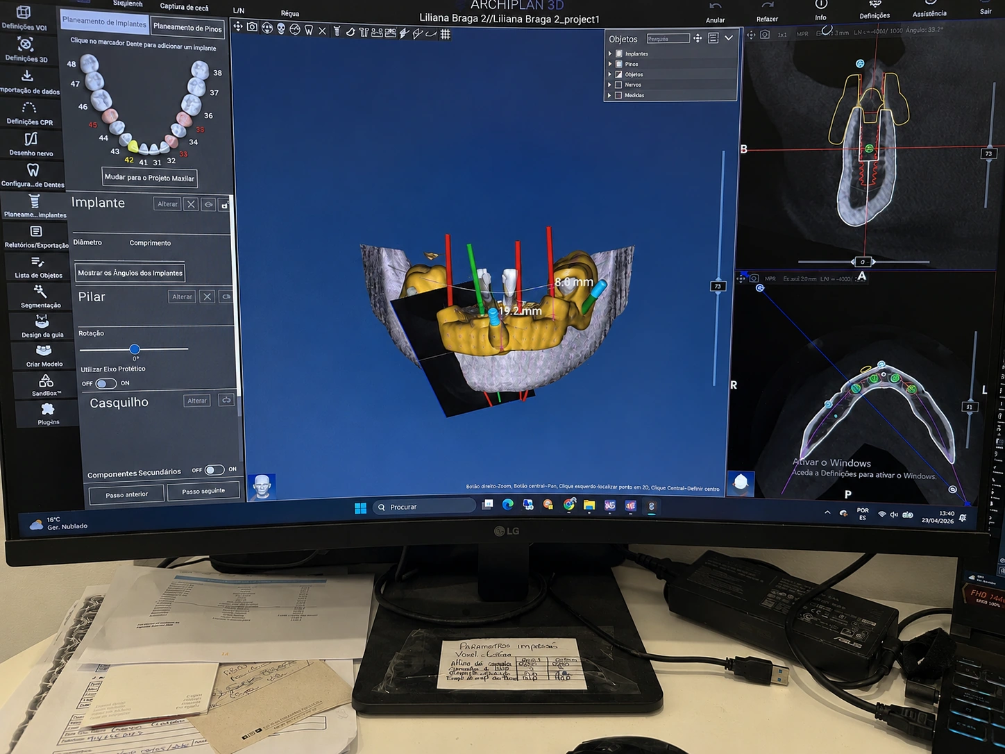 Planeamento digital 3D de caso All-on-4 na Porto Smile
