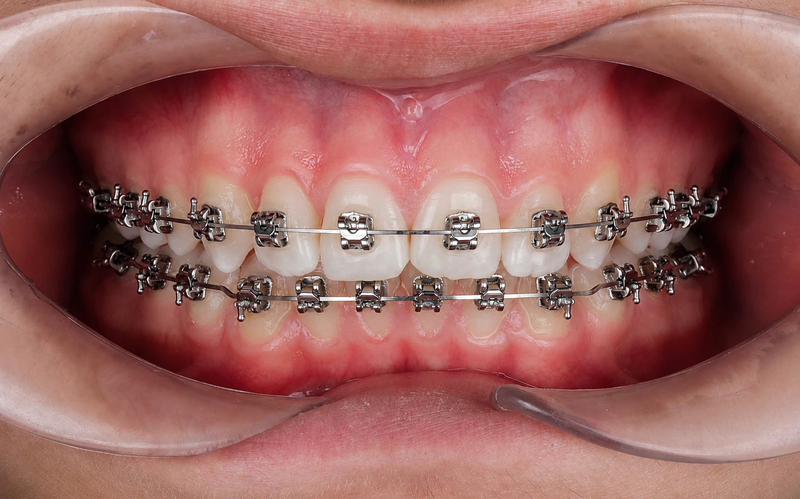 Ortodontia com alinhadores Porto Smile