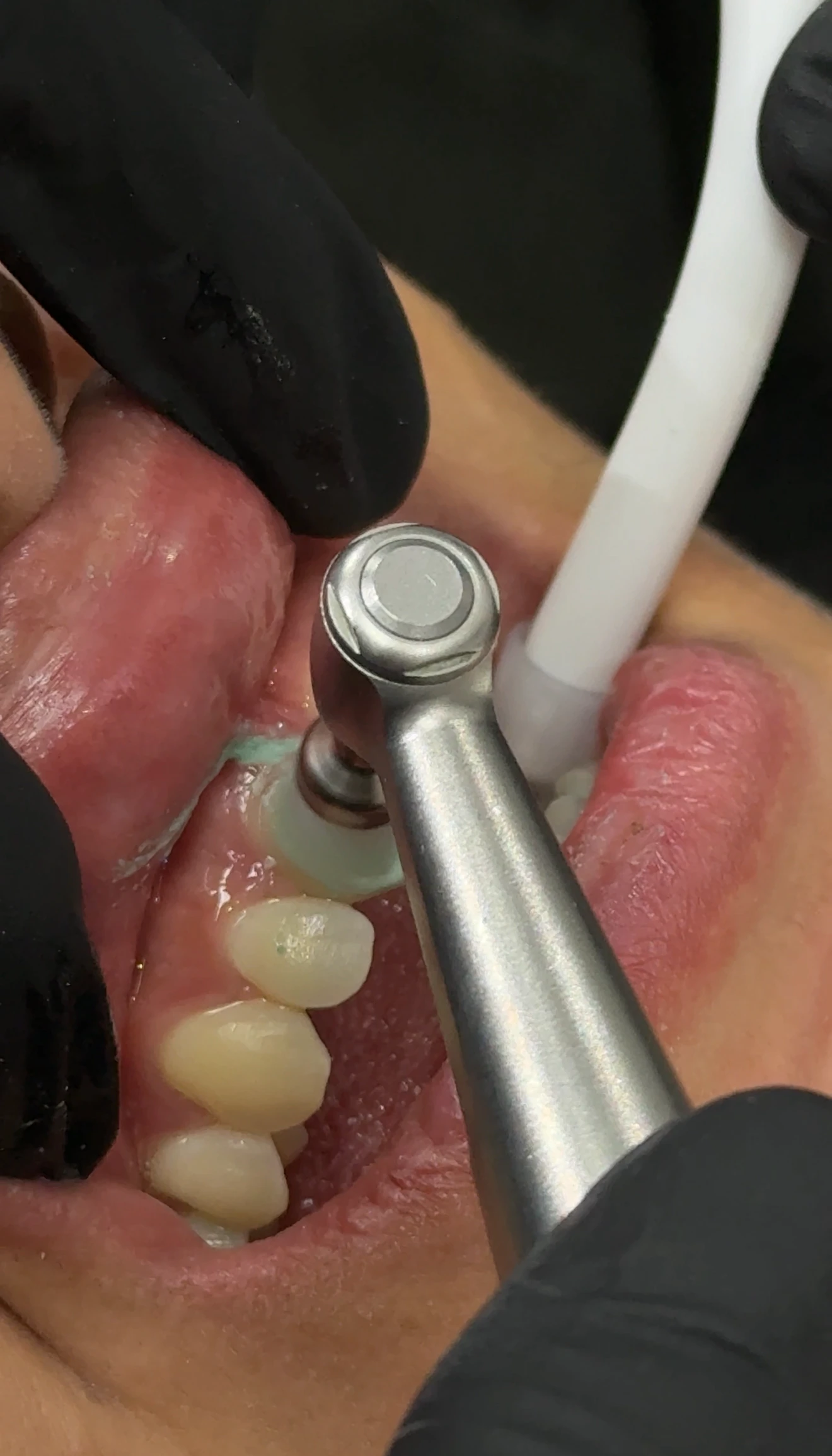 Consulta de avaliação periodontal na Porto Smile