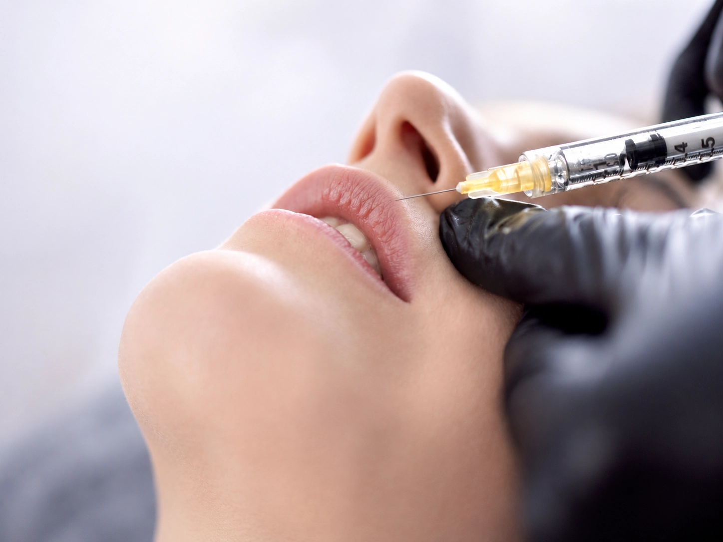 Harmonização facial resultado natural Porto Smile