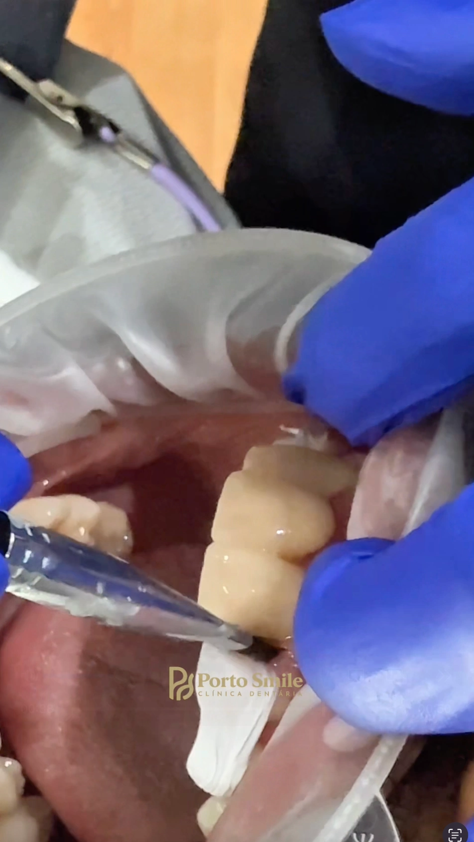 Colocação final da restauração dentária na Porto Smile