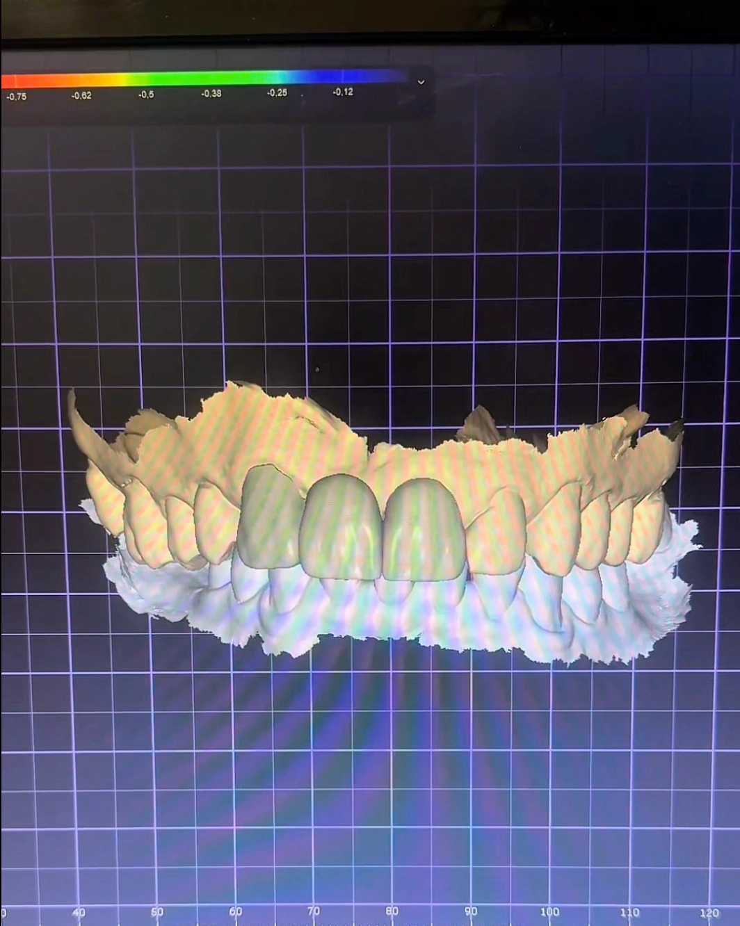 Análise digital de precisão do encaixe dentário na Porto Smile