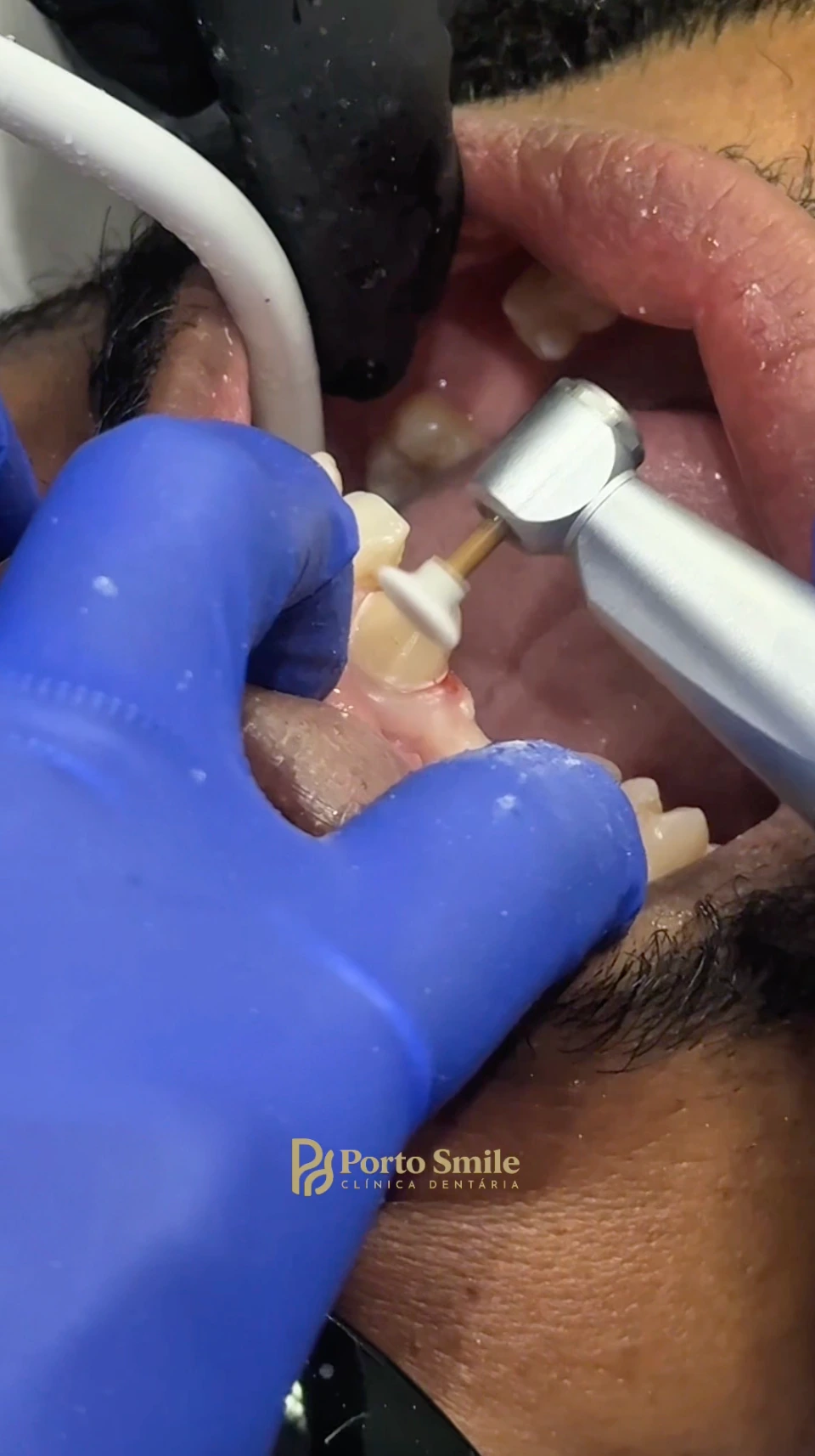 Ajuste de precisão da restauração dentária na Porto Smile